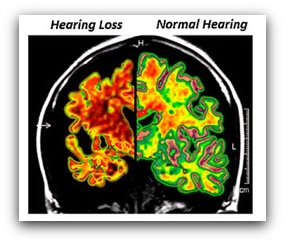 hearing loss brain function